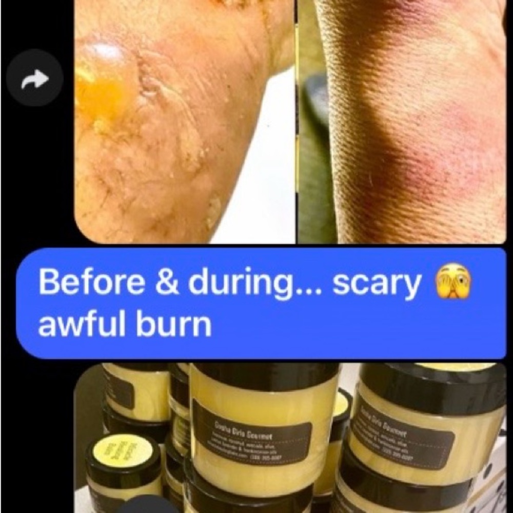 MIRACLE 👑 HEALING ❤️‍🩹 BALM Healing Skin Salve - 5 ⭐️ #beard #burns #scars #cuts